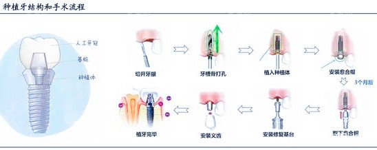 牙科最新材料的革新与应用